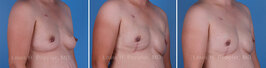 Breast reconstruction surgery before and after photos, right 45-degree angle view