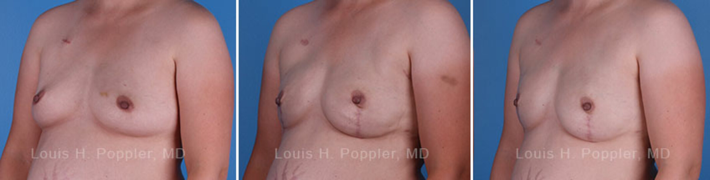 Breast reconstruction surgery before and after photos, left 45-degree angle view