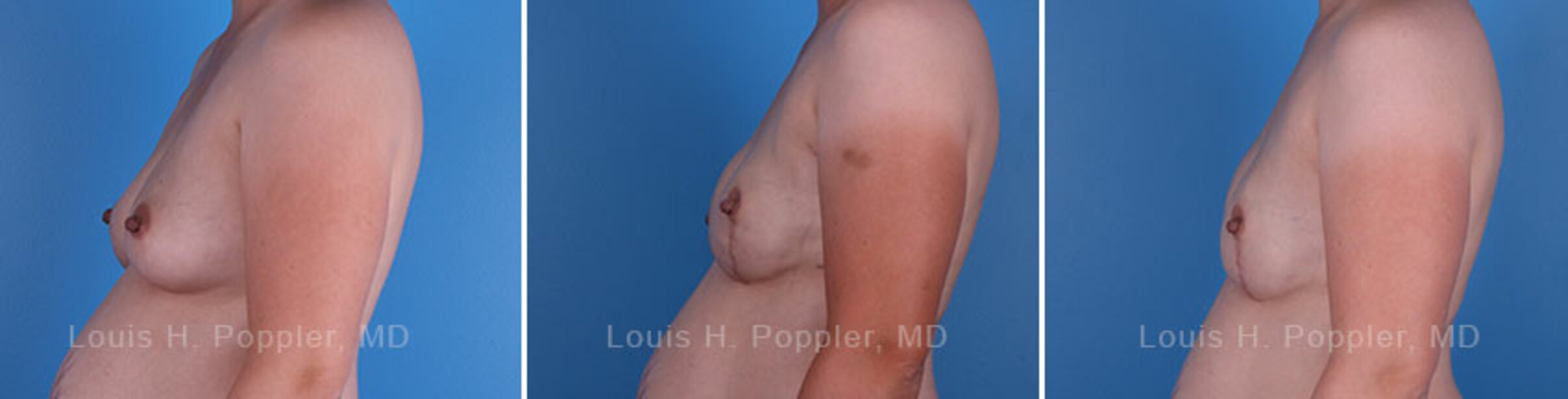 Breast reconstruction surgery before and after photos, left 90-degree angle view