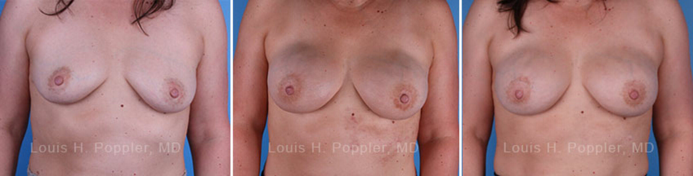 Breast reconstruction surgery before and after photos
