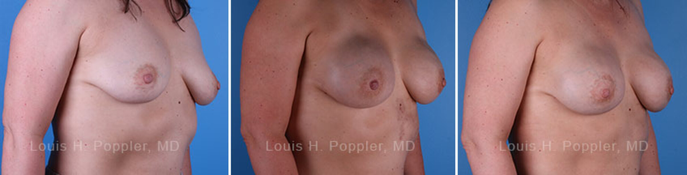 Breast reconstruction surgery before and after photos, right 45-degree angle view