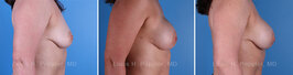 Breast reconstruction surgery before and after photos, right 90-degree angle view