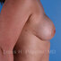Breast reconstruction surgery before and after photos, right 90-degree angle view