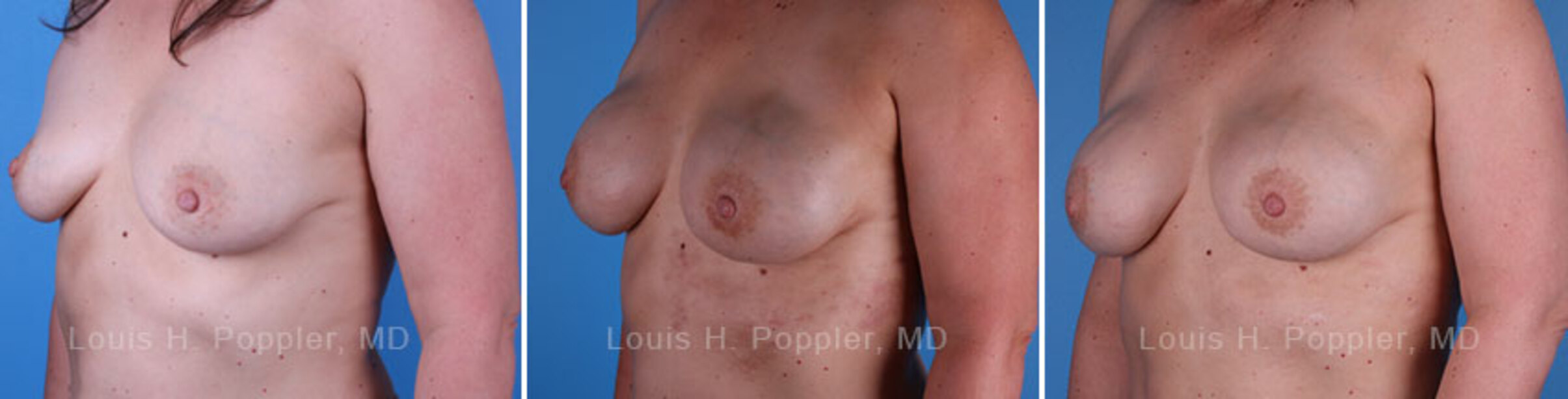 Breast reconstruction surgery before and after photos, left 45-degree angle view