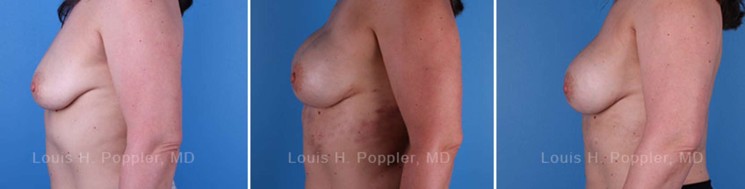 Breast reconstruction surgery before and after photos, left 90-degree angle view