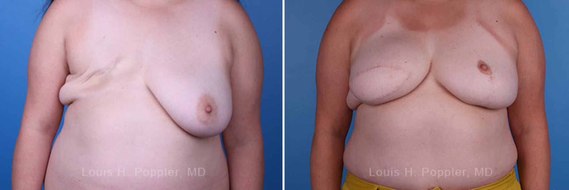 Breast reconstruction surgery before and after photos