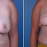 Breast reconstruction surgery before and after photos