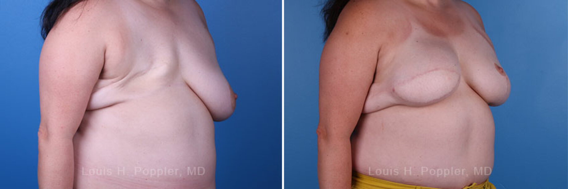Breast reconstruction surgery before and after photos, right 45-degree angle view