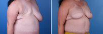 Breast reconstruction surgery before and after photos, right 45-degree angle view