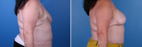 Breast reconstruction surgery before and after photos, right 90-degree angle view