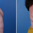 Breast reconstruction surgery before and after photos, right 90-degree angle view