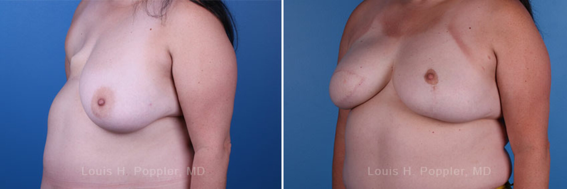 Breast reconstruction surgery before and after photos, left 45-degree angle view