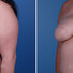Breast reconstruction surgery before and after photos, left 45-degree angle view