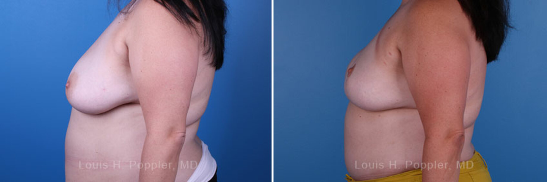 Breast reconstruction surgery before and after photos, left 90-degree angle view