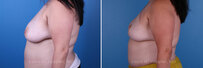 Breast reconstruction surgery before and after photos, left 90-degree angle view