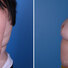Breast reconstruction surgery before and after photos, left 90-degree angle view