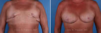 Breast reconstruction revision surgery before and after photos