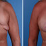Breast reconstruction revision surgery before and after photos