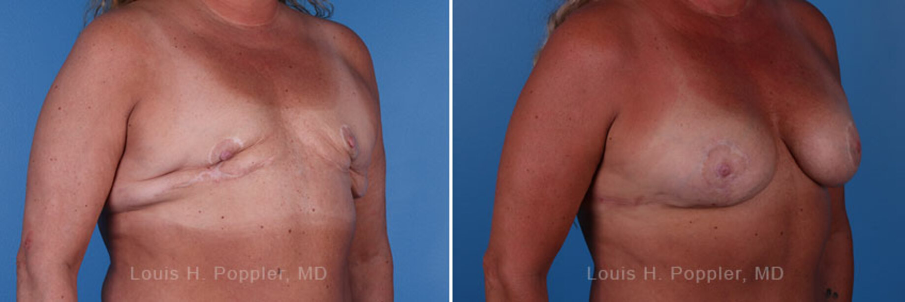 Breast reconstruction revision surgery before and after photos, right 45-degree angle view
