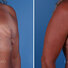 Breast reconstruction revision surgery before and after photos, right 45-degree angle view