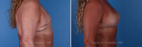Breast reconstruction revision surgery before and after photos, right 90-degree angle view