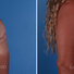 Breast reconstruction revision surgery before and after photos, right 90-degree angle view