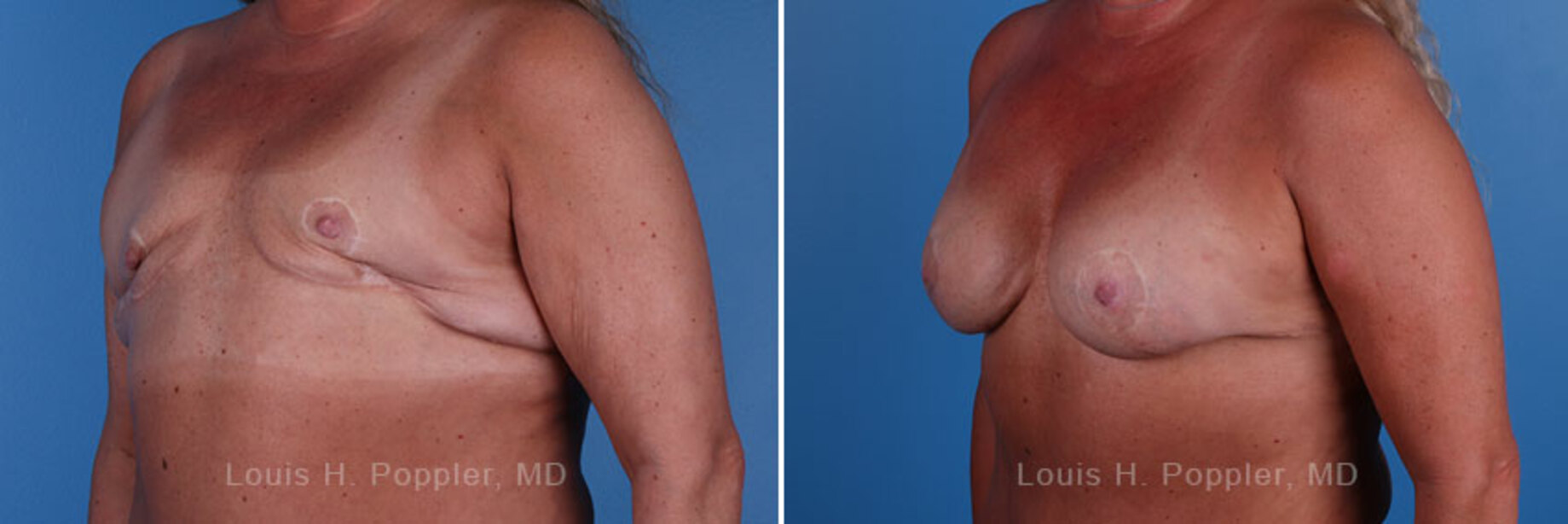 Breast reconstruction revision surgery before and after photos, left 45-degree angle view