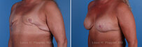Breast reconstruction revision surgery before and after photos, left 45-degree angle view