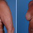 Breast reconstruction revision surgery before and after photos, left 45-degree angle view