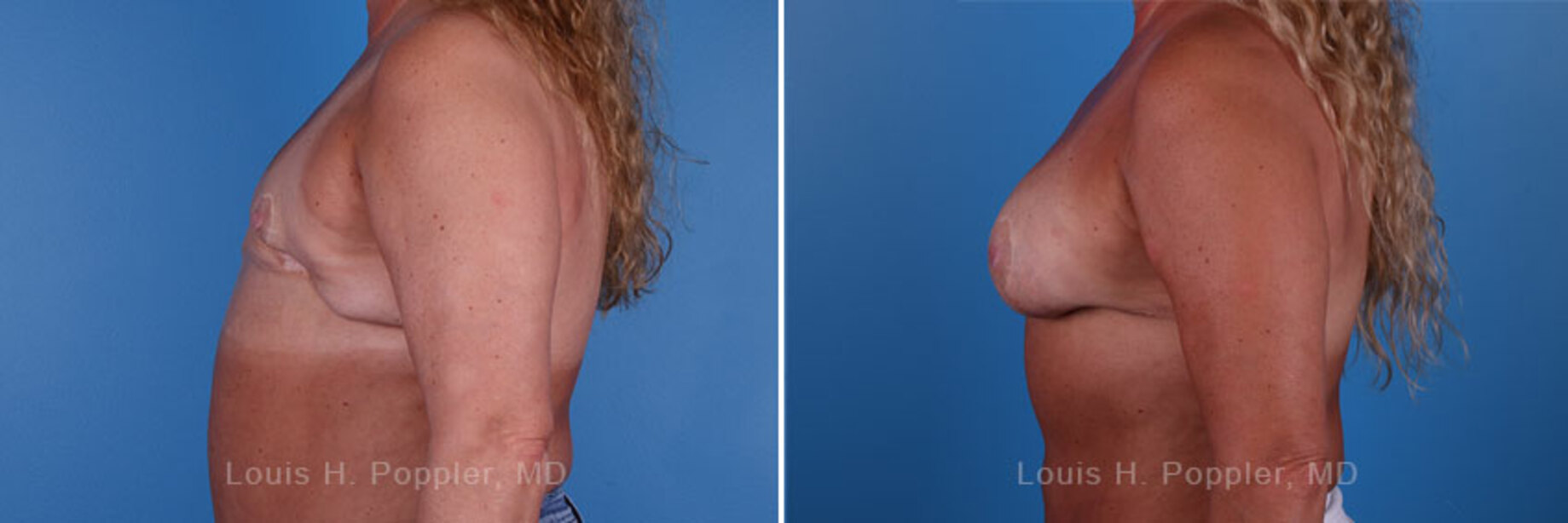 Breast reconstruction revision surgery before and after photos, left 90-degree angle view