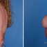Breast reconstruction revision surgery before and after photos, left 90-degree angle view