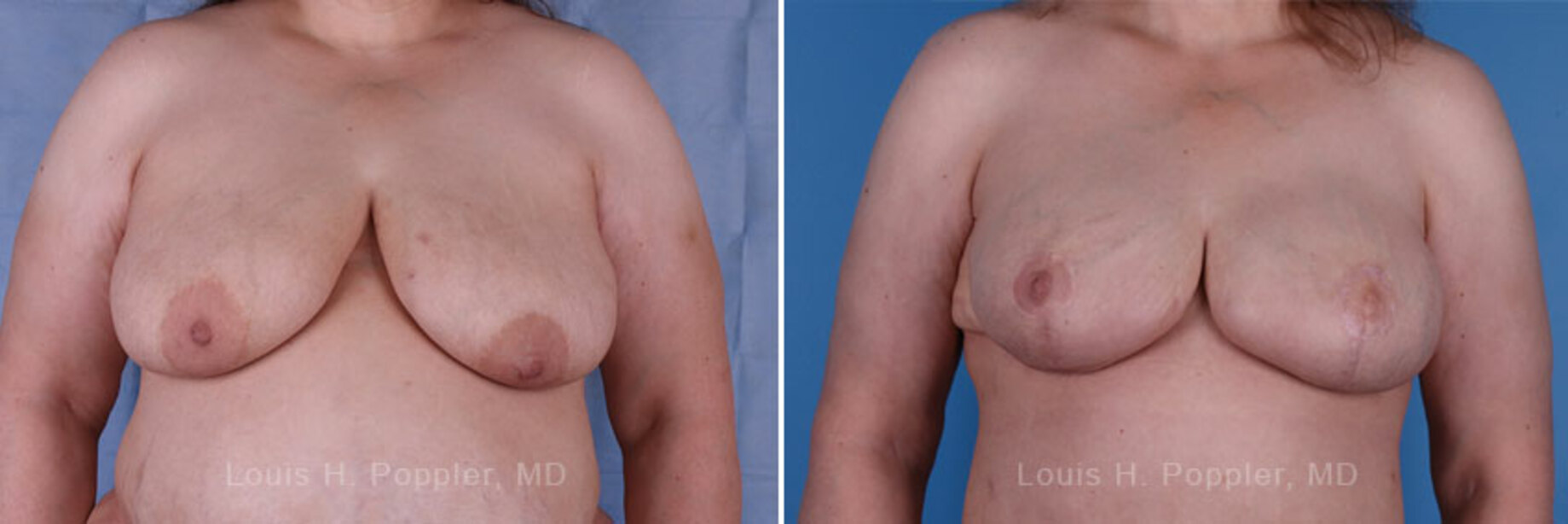 Breast reconstruction surgery before and after photos
