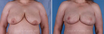 Breast reconstruction surgery before and after photos