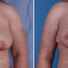 Breast reconstruction surgery before and after photos