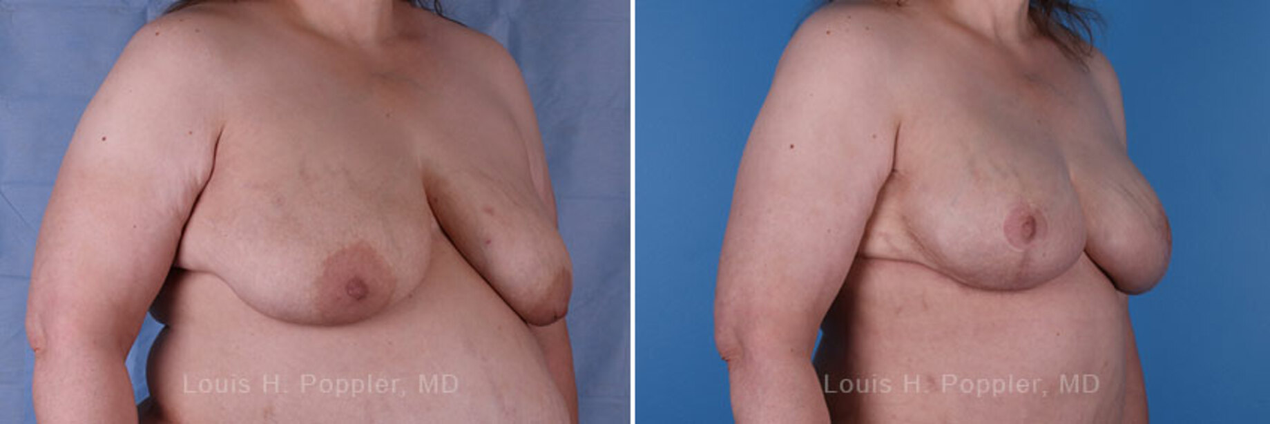 Breast reconstruction surgery before and after photos, right 45-degree angle view