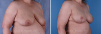 Breast reconstruction surgery before and after photos, right 45-degree angle view