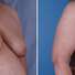 Breast reconstruction surgery before and after photos, right 45-degree angle view