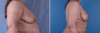 Breast reconstruction surgery before and after photos, right 90-degree angle view