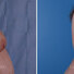 Breast reconstruction surgery before and after photos, right 90-degree angle view