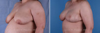 Breast reconstruction surgery before and after photos, left 45-degree angle view