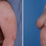 Breast reconstruction surgery before and after photos, left 45-degree angle view