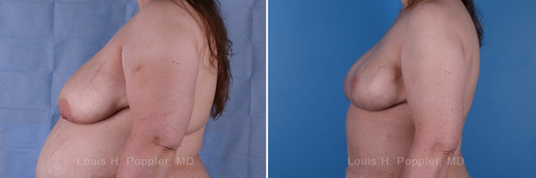 Breast reconstruction surgery before and after photos, left 90-degree angle view