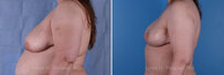 Breast reconstruction surgery before and after photos, left 90-degree angle view