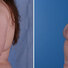 Breast reconstruction surgery before and after photos, left 90-degree angle view