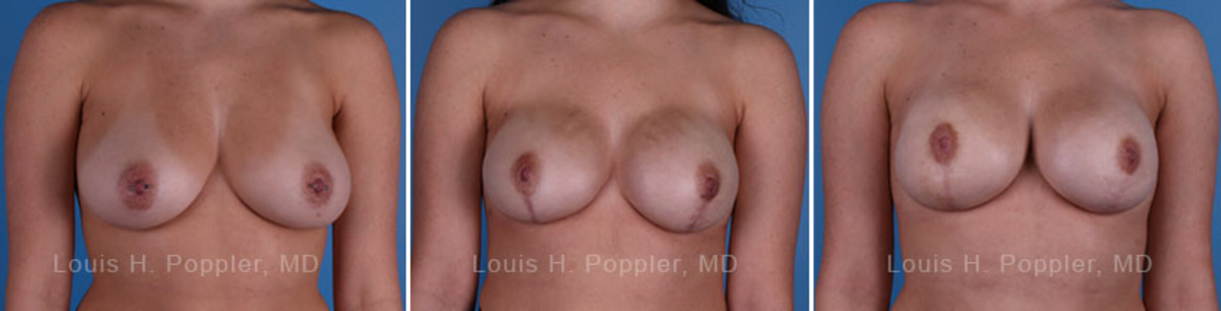 Breast reconstruction surgery before and after photos