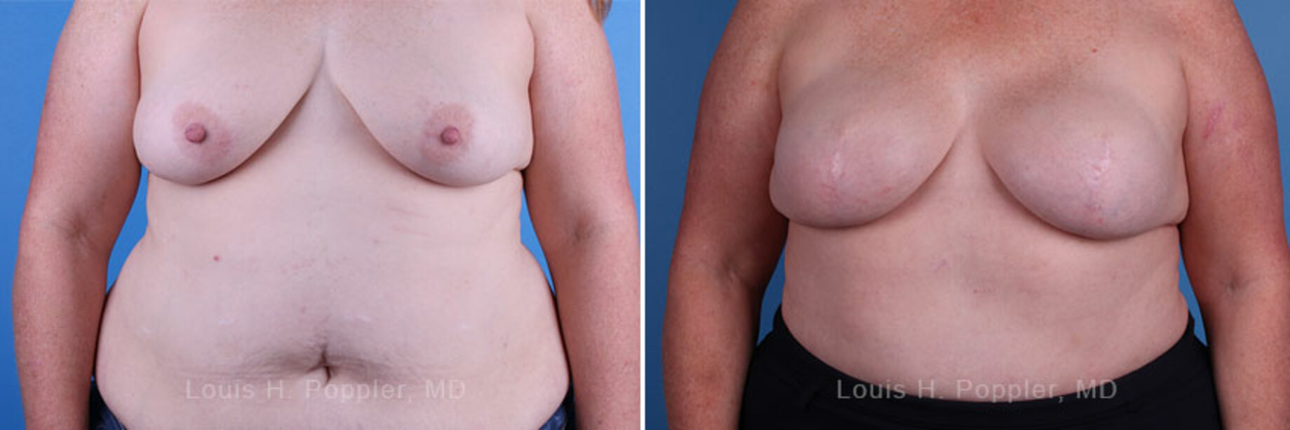 Breast reconstruction surgery before and after photos
