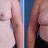 Breast reconstruction surgery before and after photos