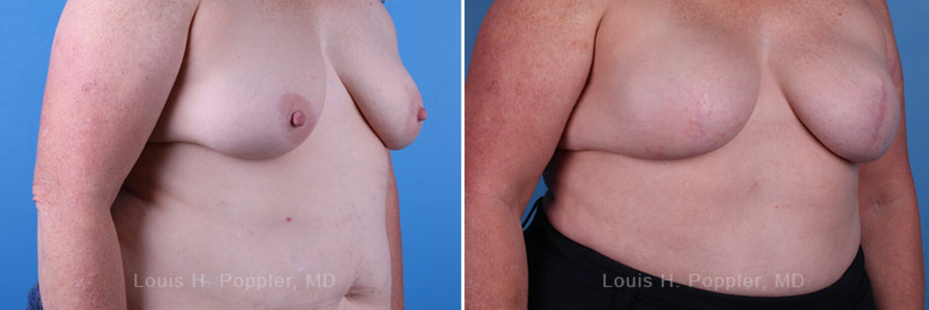 Breast reconstruction surgery before and after photos, right 45-degree angle view