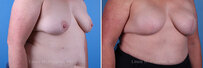 Breast reconstruction surgery before and after photos, right 45-degree angle view
