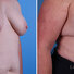Breast reconstruction surgery before and after photos, right 45-degree angle view